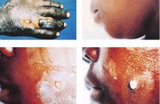 Child with cutaneous anthrax infection