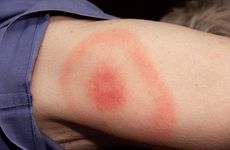 The bullseye rash that is typical of Lyme disease