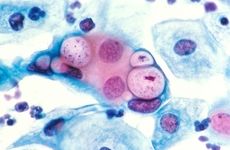 A pap smear