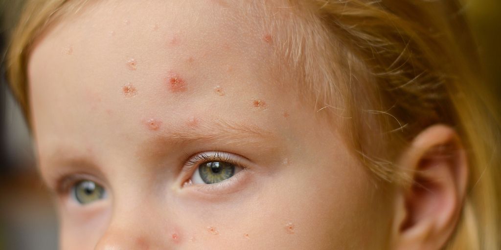 Commercial, Academic Labs Ramping Up Monkeypox Testing Efforts - Vimarsana News