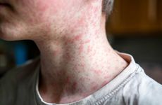 Measles