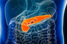 Pancreatic cancer