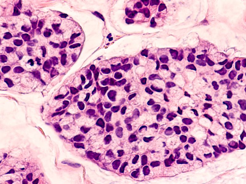 Agendia Offering AI-Enabled Genomic Test for Breast Cancer in Brazil as it Eyes Global Market - Vimarsana News
